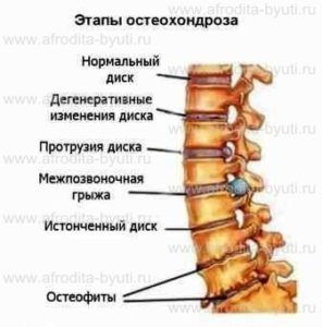 как вылечить остеохондроз