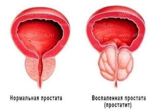 Симптомы и лечение хронического простатита